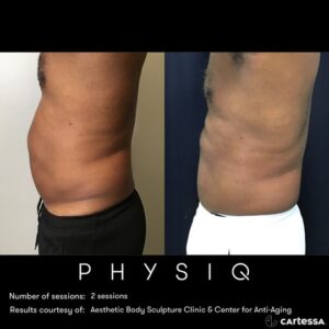 PH_Before/After_Slater Abs male