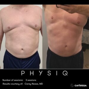 PH_Before/After_Nease